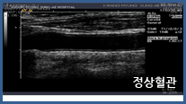 경동맥 초음파 사진1
