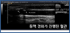 경동맥 초음파 사진2